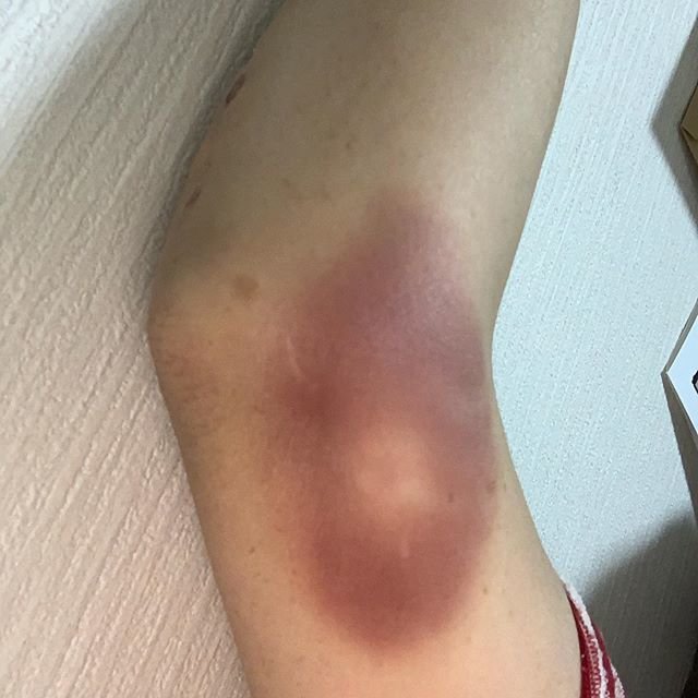 ゆりお on Instagram: “もー最悪⤵︎歳のせいか　治りが悪っ?ってか、汚いしっ?? はい。はい。歳です。　おっさんデス‼ ️ #打撲  #悪化  #歳のせい#治り悪っ　#みんな心配せず大爆笑してるって” (87242)